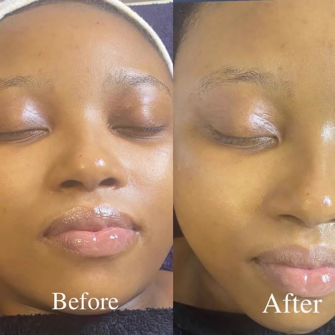 Documented clinical before and after outcome for facial radiance and hydration
