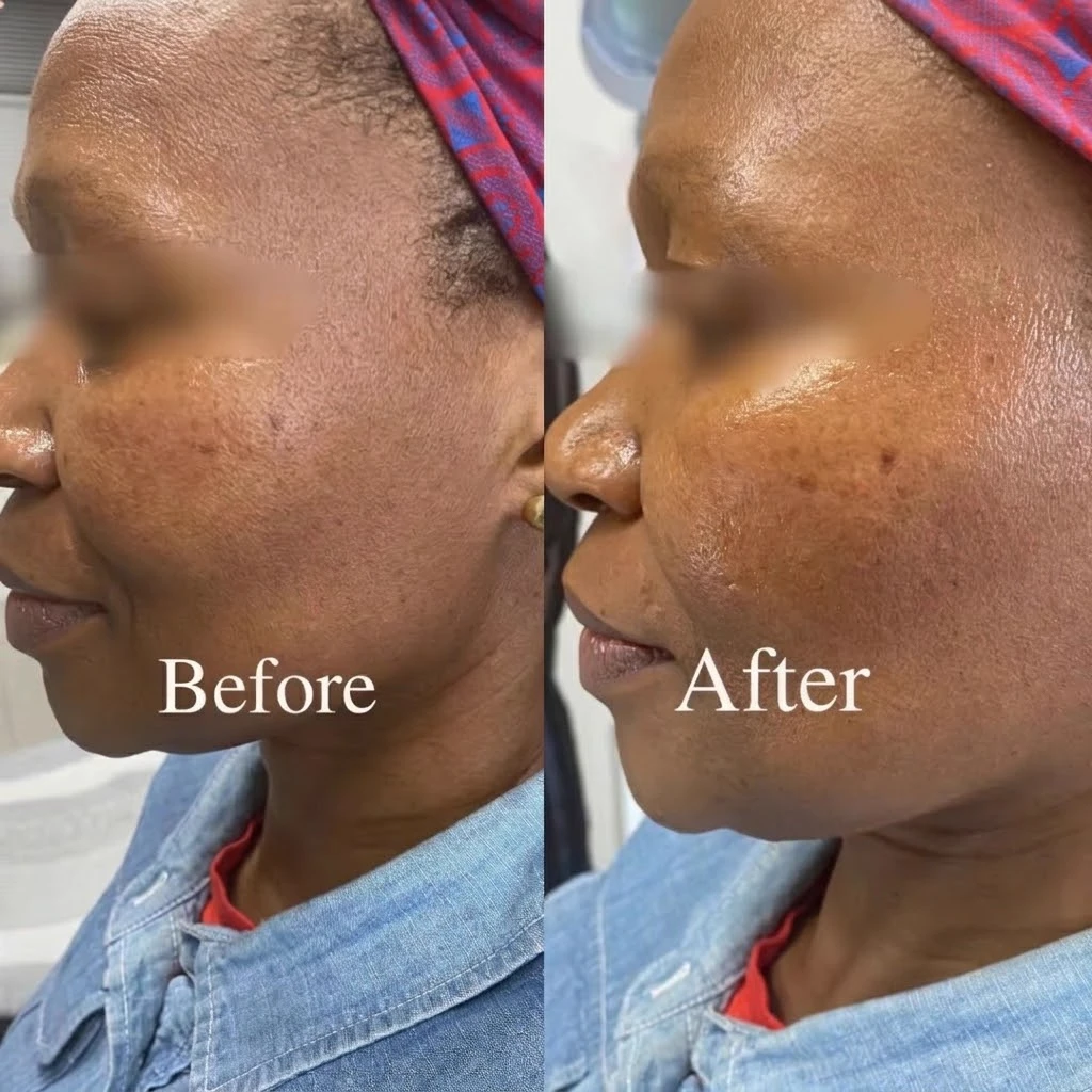 Documented clinical before and after outcome for hyperpigmentation treatment