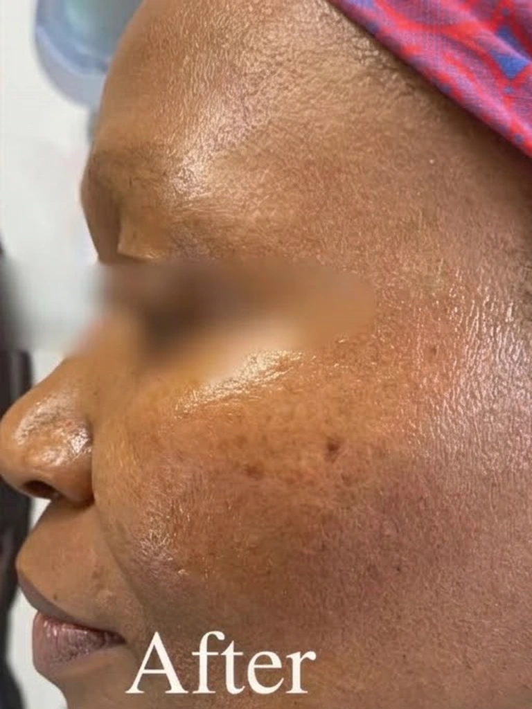 Documented clinical outcome showing clear, luminous, and refined complexion following Dr. Ndlela's medical aesthetic protocol