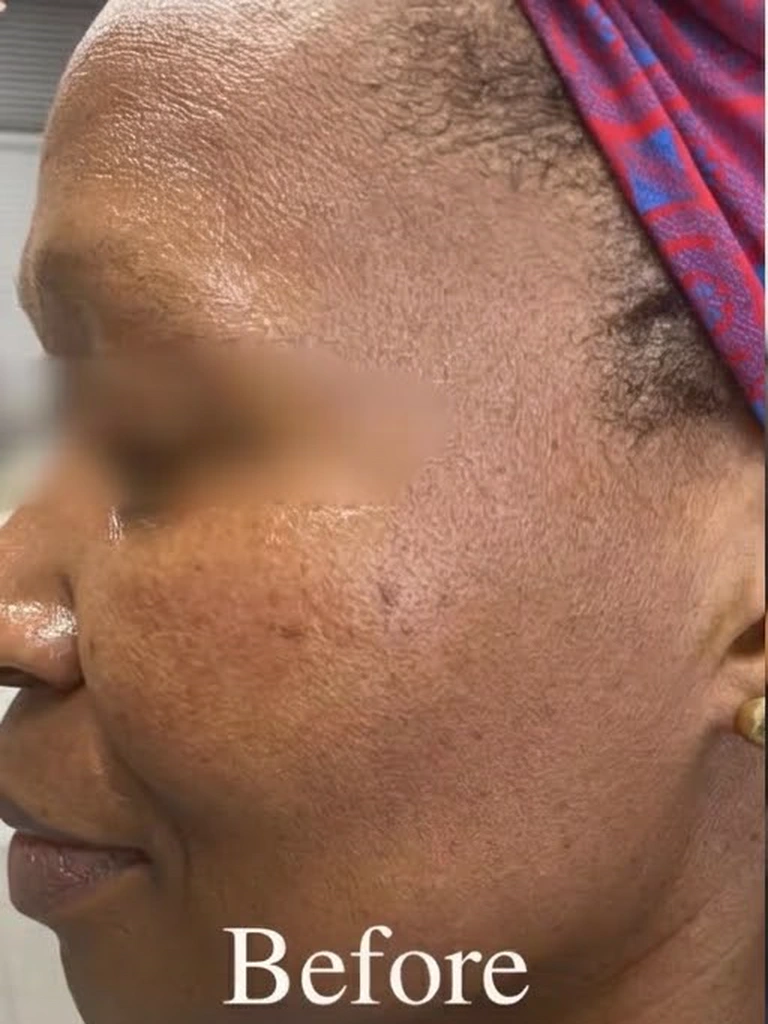 Documented clinical baseline showing deep zygomatic post-inflammatory hyperpigmentation prior to medical peel protocol