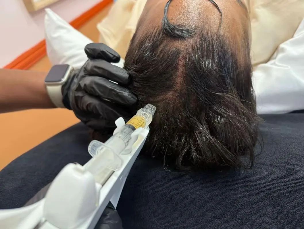 Autologous PRP follicular scalp stimulation outcome