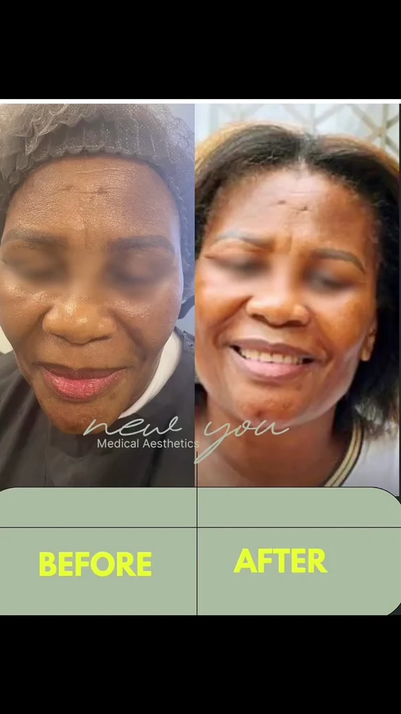 Documented full facial rejuvenation and anti-wrinkle outcome